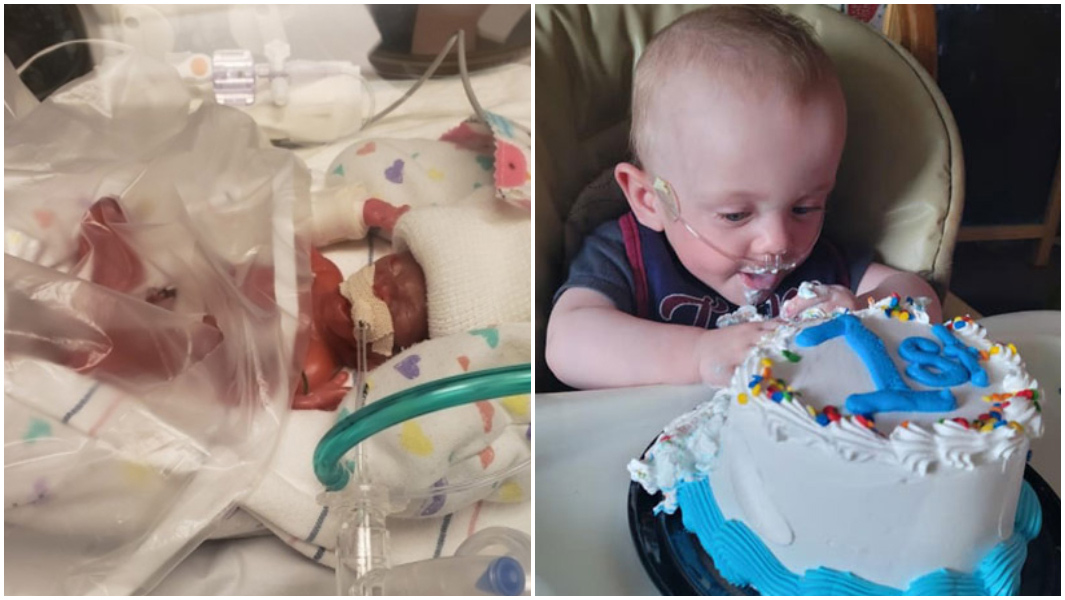 most premature baby days old and celebrating first birthday with cake
